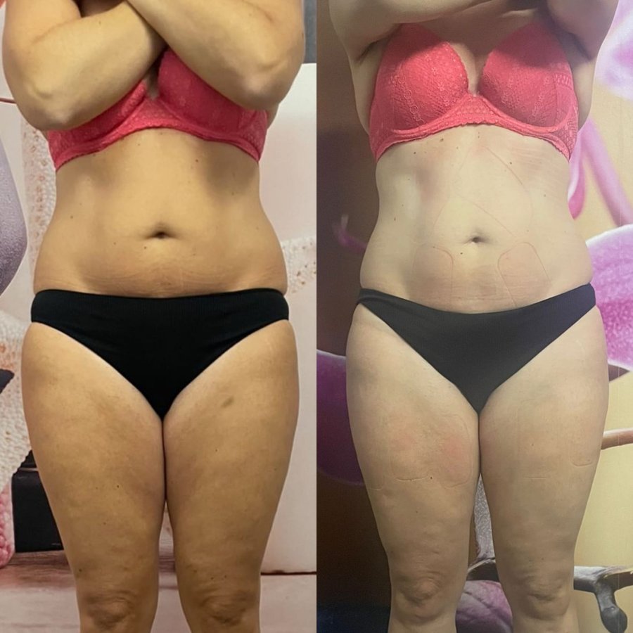 Vorher-Nachher-Vergleich Vorderansicht Bauch